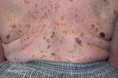 Seborrheic-Keratosis