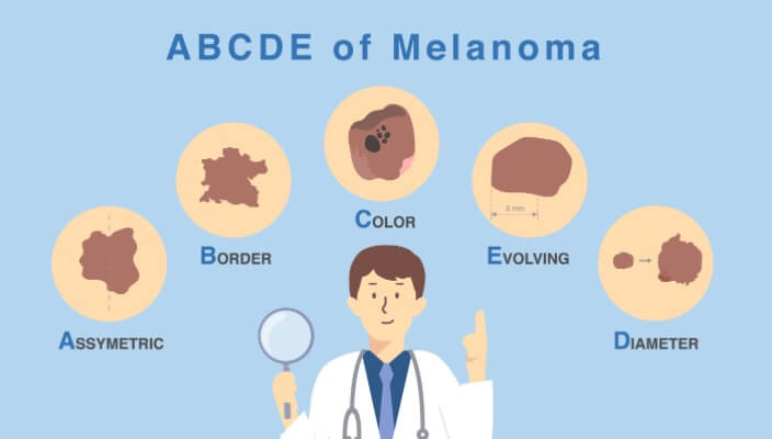 ABCDEs of Melanoma graphic)