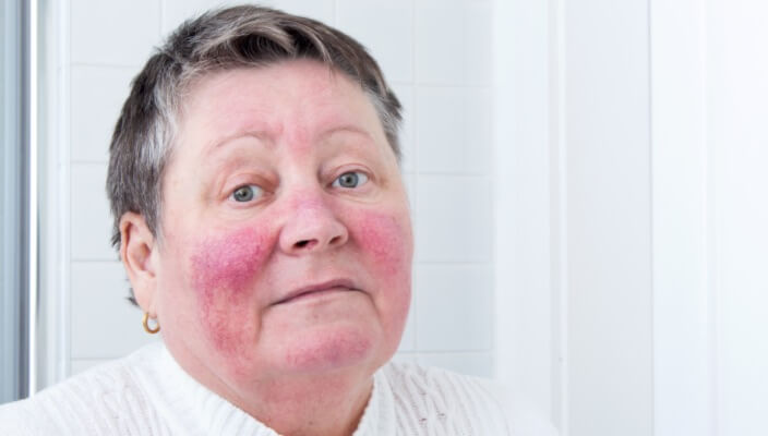 woman with rosacea