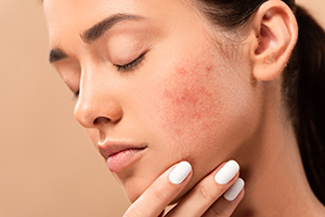 Acne Causes
